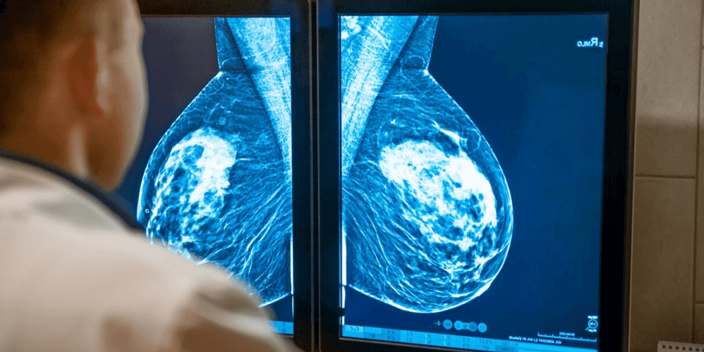 The Difference Between Dense and Nondense Breast Tissue